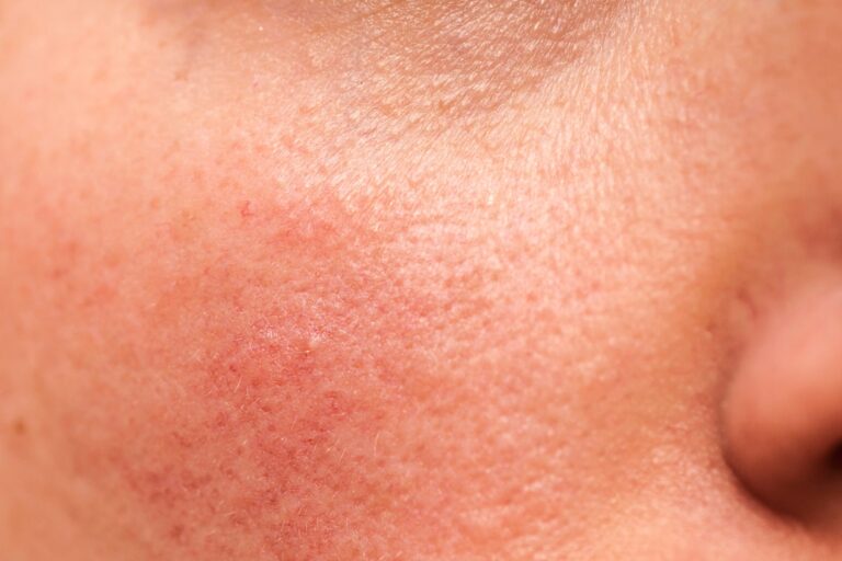 Skóra wrażliwa -  jak ją rozpoznać i jak o nią dbać?